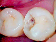 自覚症状がないのに虫歯が進行する？(ドックベストセメントの効用)