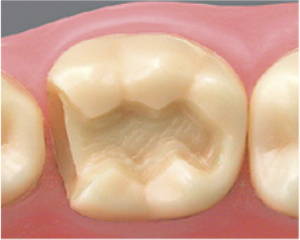 インレー装着前の歯面