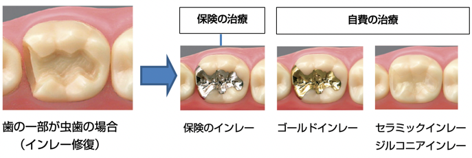 の一部が虫歯の場合 （インレー修復