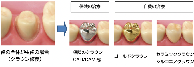 の全体が虫歯の場合 （クラウン修復）