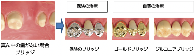 ん中の歯がない場合 ブリッジ