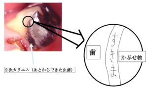 ２次う蝕ができている場所の説明