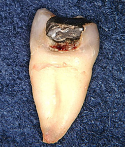 抜歯された歯から読み解く銀歯と歯の境目からの２次う蝕