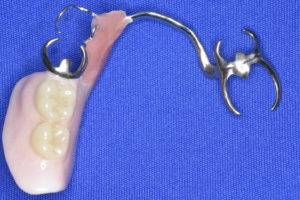 下顎のリンガルバー付きのクラスプ義歯