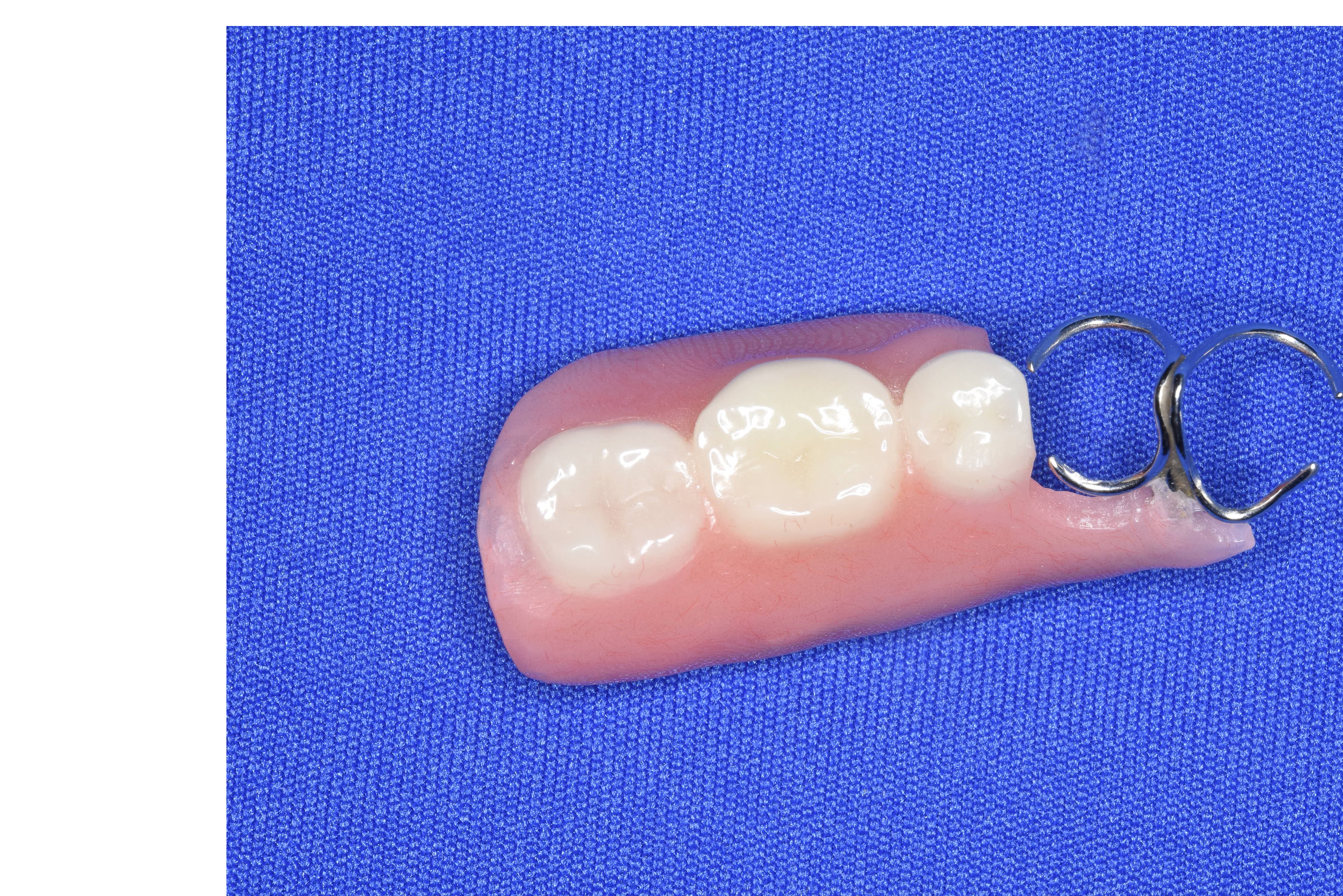 奥歯：歯の大切さに順位があるとしたら最も重要な存在 - レガデンタル