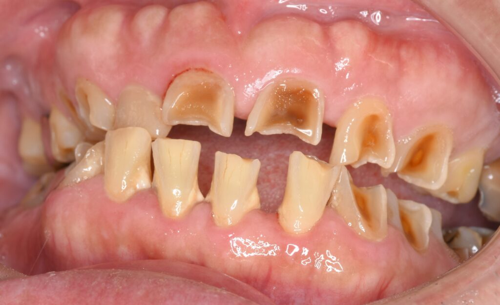 治療したのに、歯が噛むと痛んだり腫れたりする…その原因は？